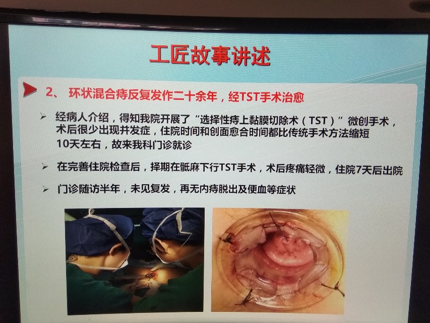 环状混合痔反复发作二十余年经我科采用tst手术治愈