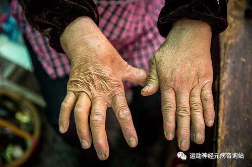 运动神经元病会给患者带来什么样的危害