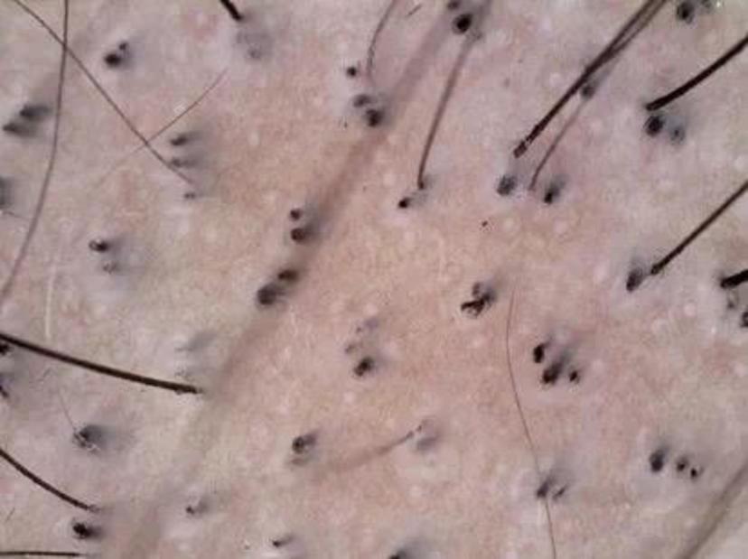 儿童脱发小心拔毛癖