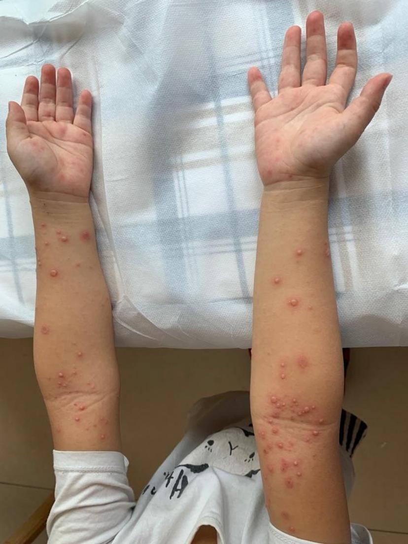 带你认识手足口有图