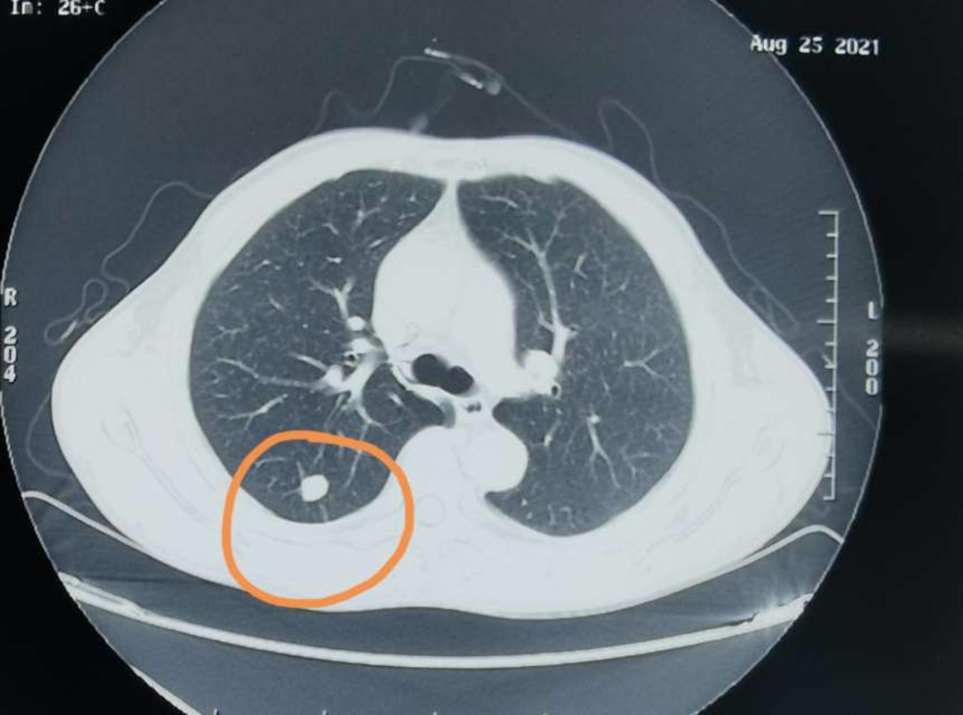 刘懿博士说肺癌(二五九〇)切之前知道俩肺结节是良性,但不是一种病