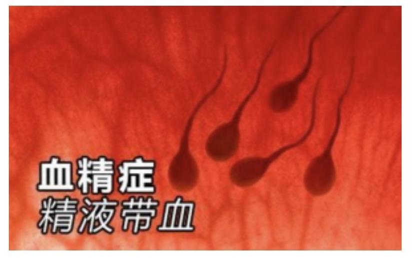 精液带血是怎么回事_罗华荣医生文章_上海市同济医院-微医