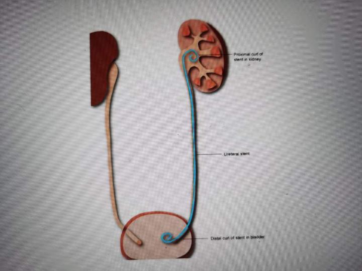 啥时候要放输尿管支架管双j管