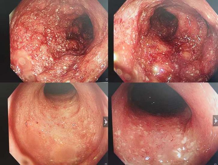 溃结患者疗效反馈
