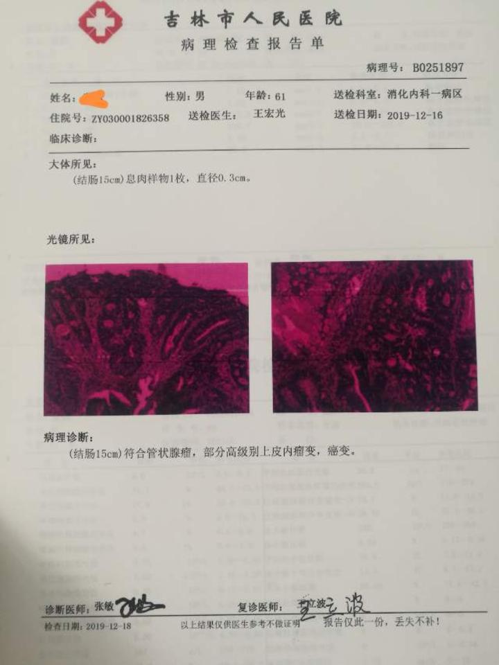 发现1厘米以下结直肠息肉癌变1例