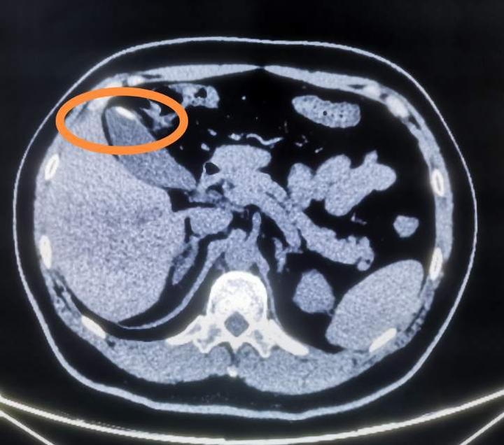 胆囊瓷化的情况临床相对少见.
