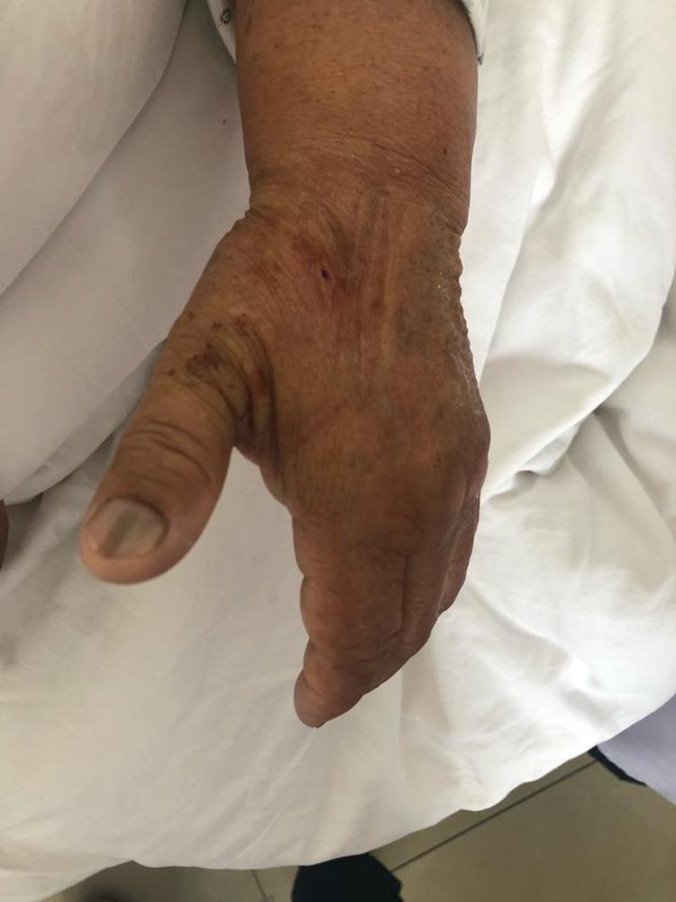 冠脉造影的新途径-桡动脉远端穿刺