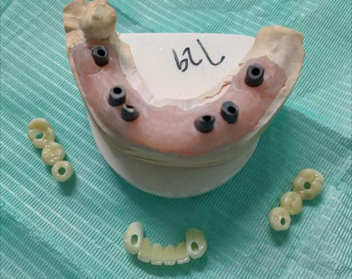 牙列缺失的修复种植固定义齿