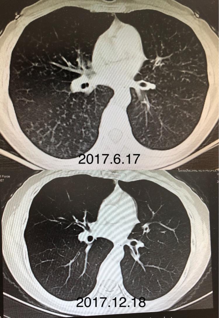 2017年6月胸部ct提示双肺弥漫性小结节影,散在支气管扩张.