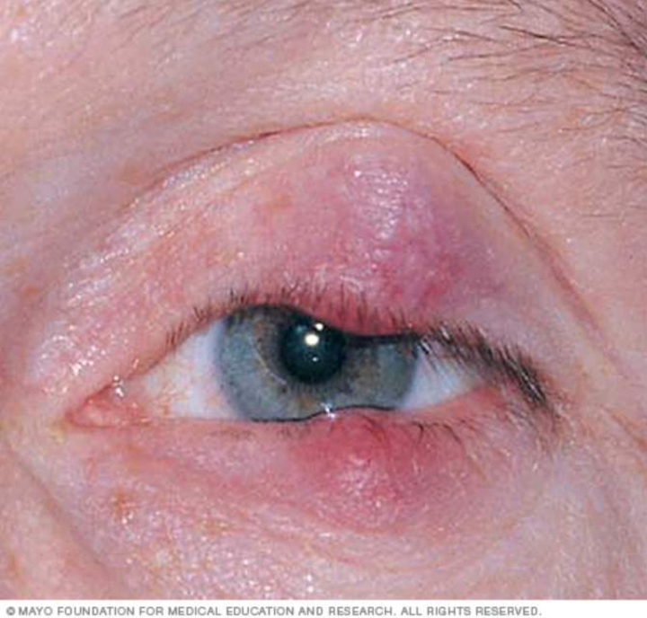 怎么判断宝宝得了霰粒肿