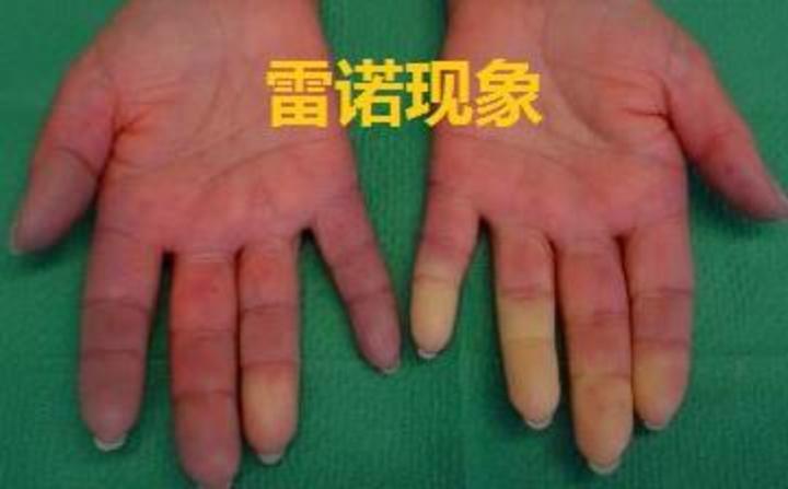 初开始感双手指皮肤发紧发硬,就来医院检查,综合临床表现和实验室检查