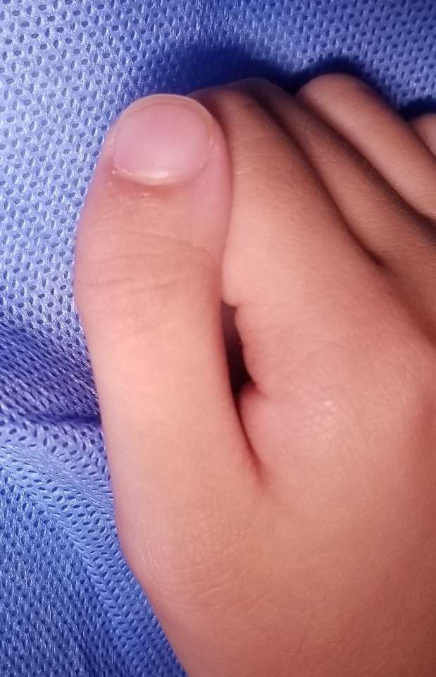 大拇指弯曲的常见原因,三节拇