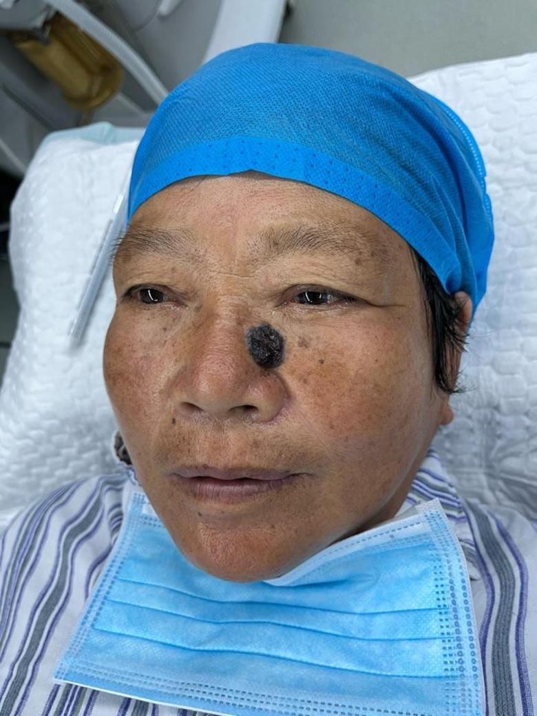 鼻背基底细胞癌扩切皮瓣修复