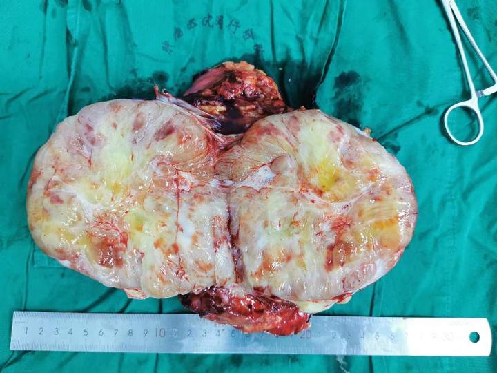 腹膜后肿瘤精准施治