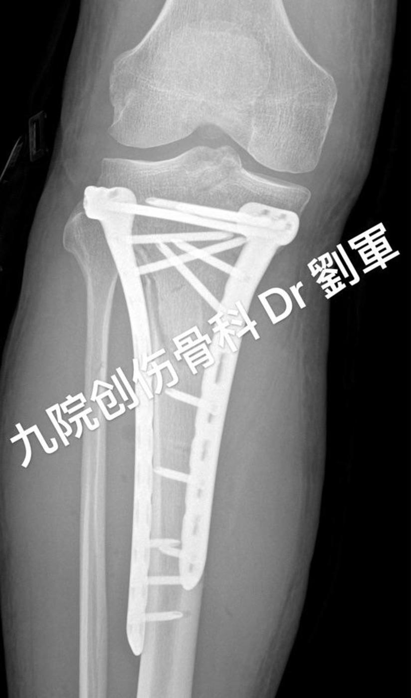 胫骨平台骨折一例 健康号 微医
