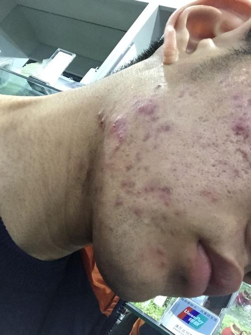 青春痘痤疮的有效治疗方法