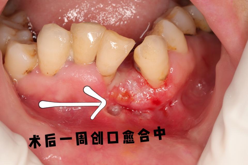 牙龈瘤,门诊手术微创摘除