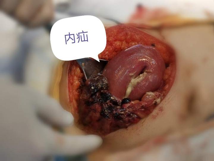 腹部闭合性损伤不容小觑