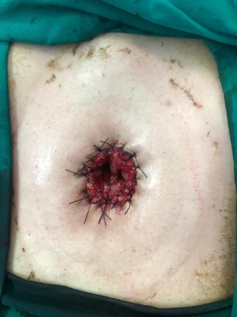 结肠造口狭窄的手术处理_全应军医生文章_上海交通大学医学院附属同仁