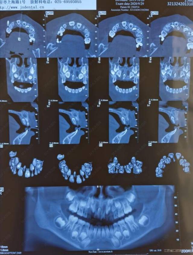 儿童上颌埋伏多生牙拔除(病例) 