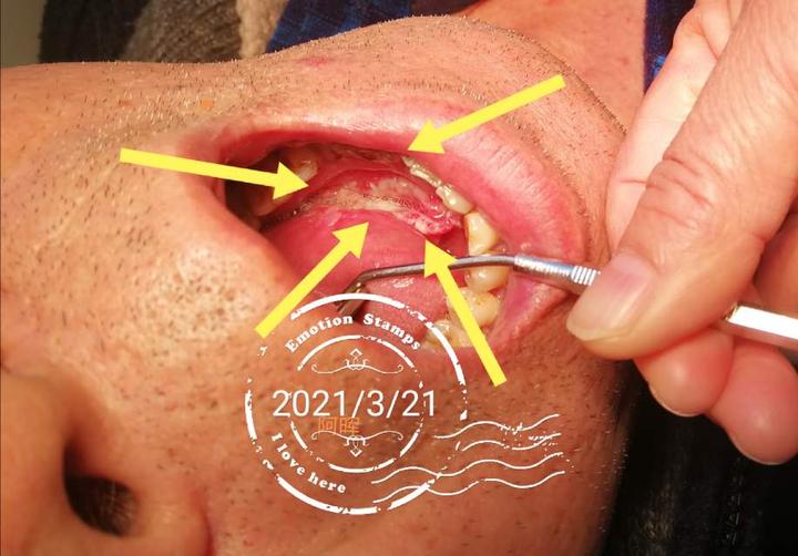 口腔舌头底下溃烂疼痛