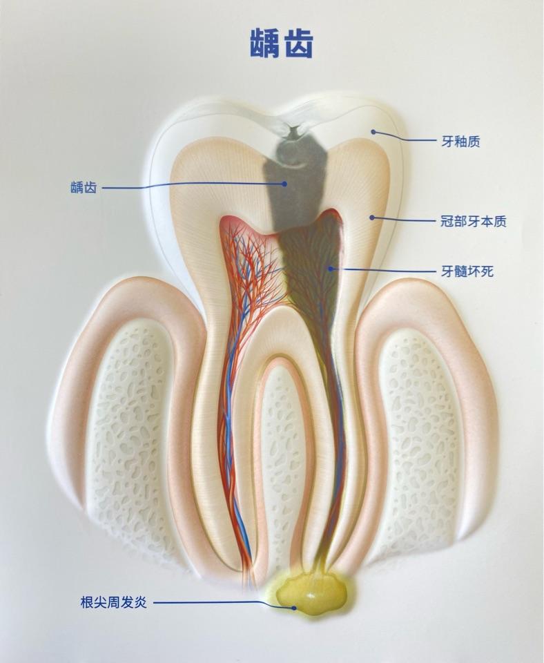 牙髓位置图图片