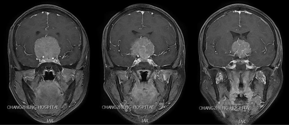 磁共振發現前顱底蝶谷平臺及鞍結節巨大腦膜瘤,約6*7cm大小,後方壓迫