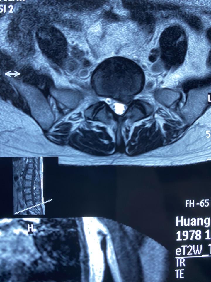 腰间盘突出磁共振图片图片