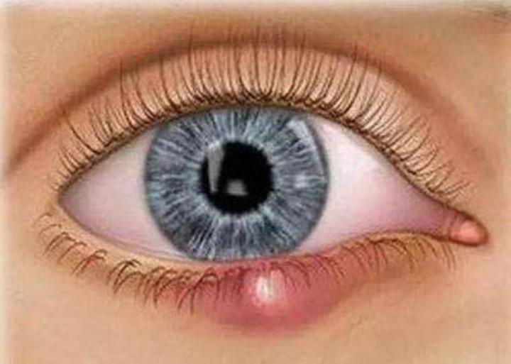 可能由于慢性结膜炎或睑缘炎导致睑板腺出口阻塞,腺体的分泌物潴留在