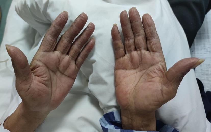 副癌综合征肢端角化症