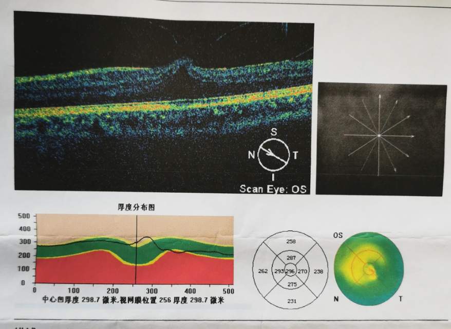 玻璃体黄斑牵拉一例自行恢复实属万幸