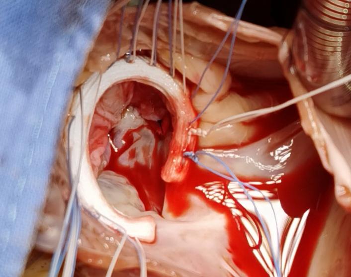 三尖瓣瓣叶拓宽重建技术修复严重三尖瓣关闭不全