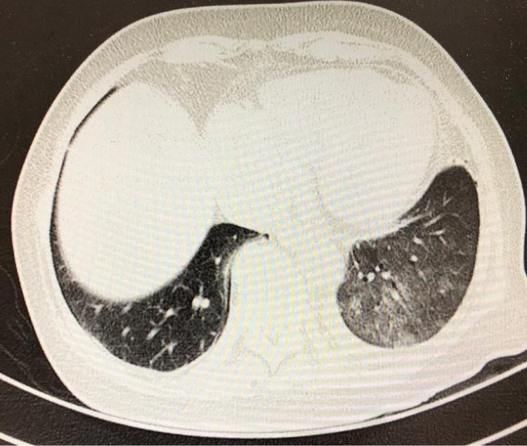 病例展示系列3复张性肺水肿