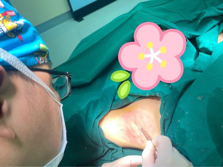 正确认识微创腋臭手术