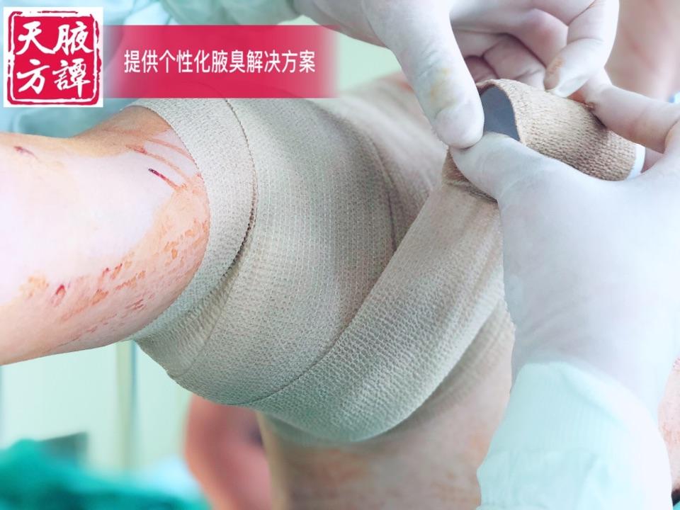 纱布绷带,普通弹性绷带,自粘弹性绷带的多种包扎材料被应用于腋臭术后