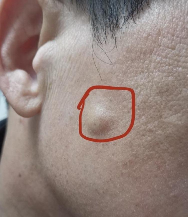 皮脂腺囊肿怎么治疗