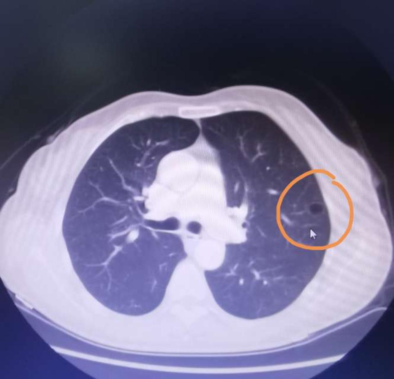 刘懿博士说肺癌三〇二七我说肺结节是良性找别人切了是良性么