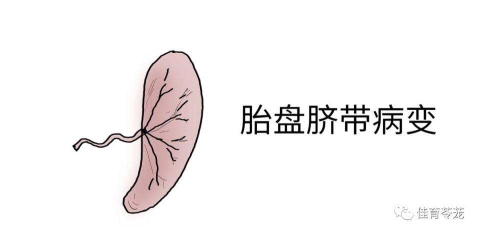 胎盘绒毛血管瘤,巨大胎盘,脐带帆状附着会导致羊水过多.
