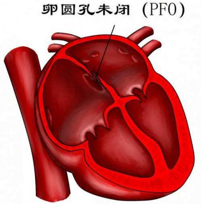 卵圆孔未闭 - 微医(挂号网)