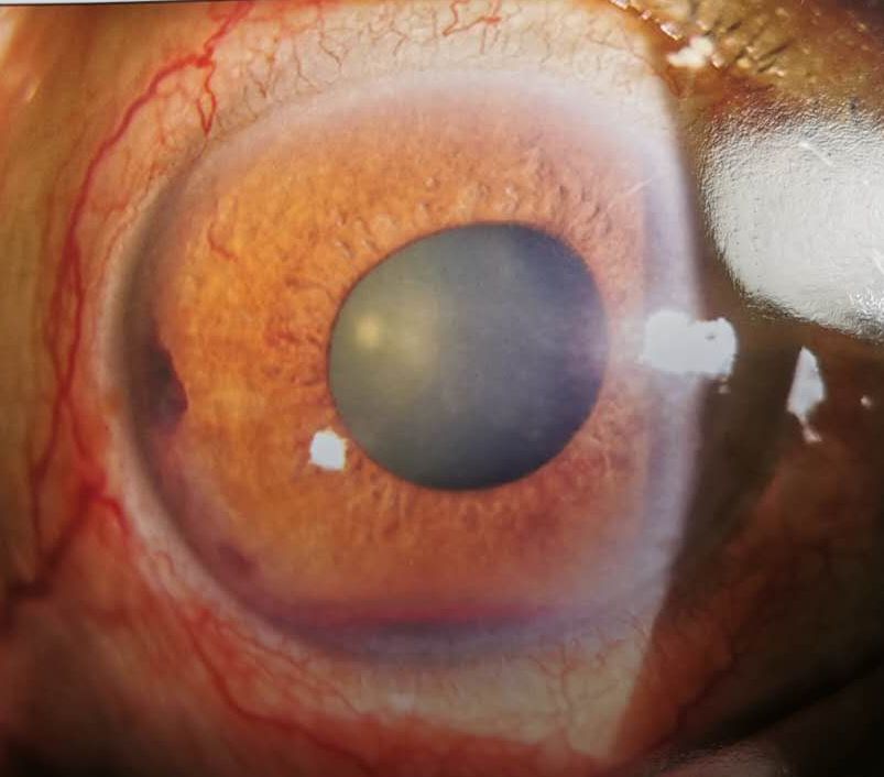 糖尿病视网膜病变要早期治疗并发症严重