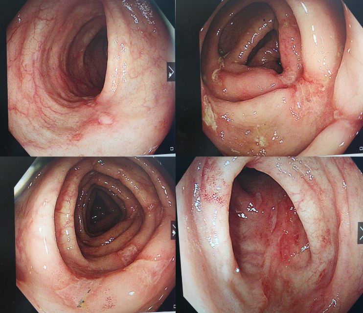 克罗恩的早期肠镜图片图片