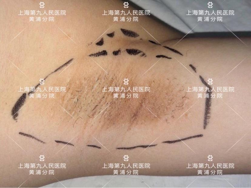 黄金微针治疗腋臭#【一千零一腋】之819 - 微医(挂号网)