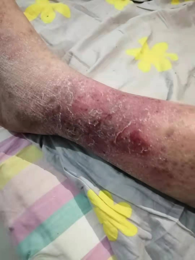 长时间久站腿部红肿皮肤烂了