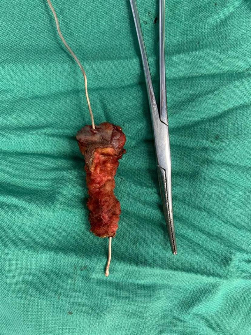 入院经做b超及磁共振确诊为复杂性肛瘘,并肛瘘切除十高位挂线术,手术