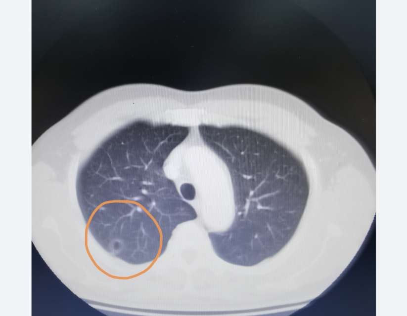刘懿博士说肺癌三五二三肺磨玻璃结节里还有小空洞切出来啥病