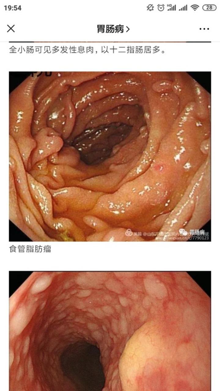 遗传相关胃肠道息肉病之cowden综合征