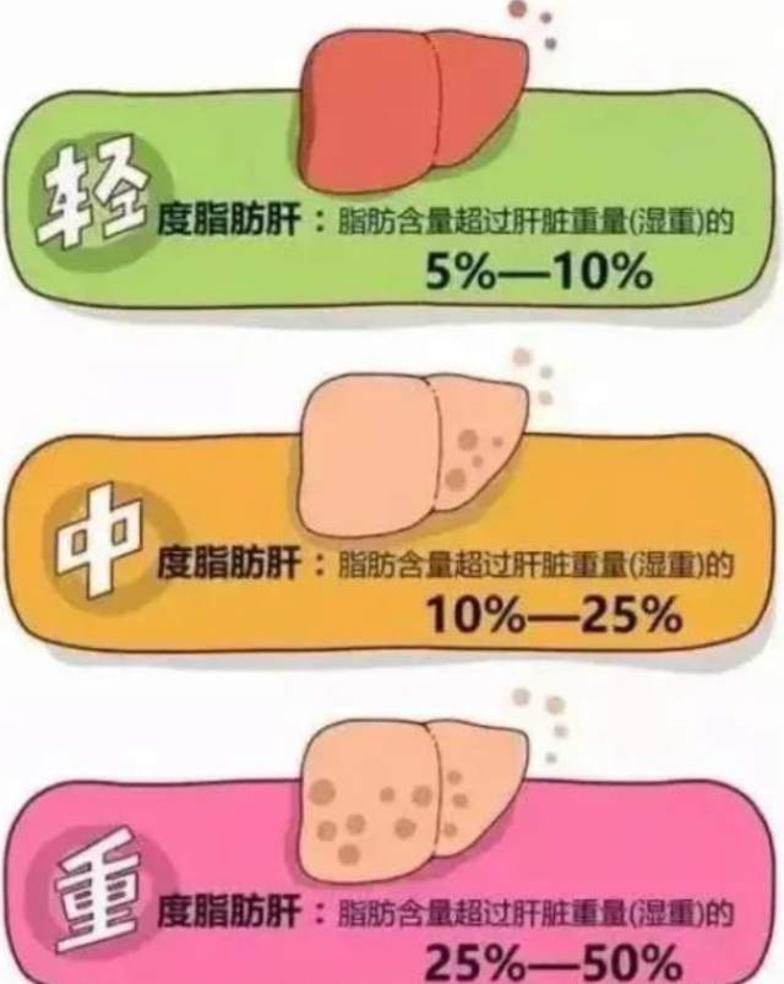 酒精性脂肪性肝病的早期表现,通常与营养过剩,肥胖,代谢综合征(高血压