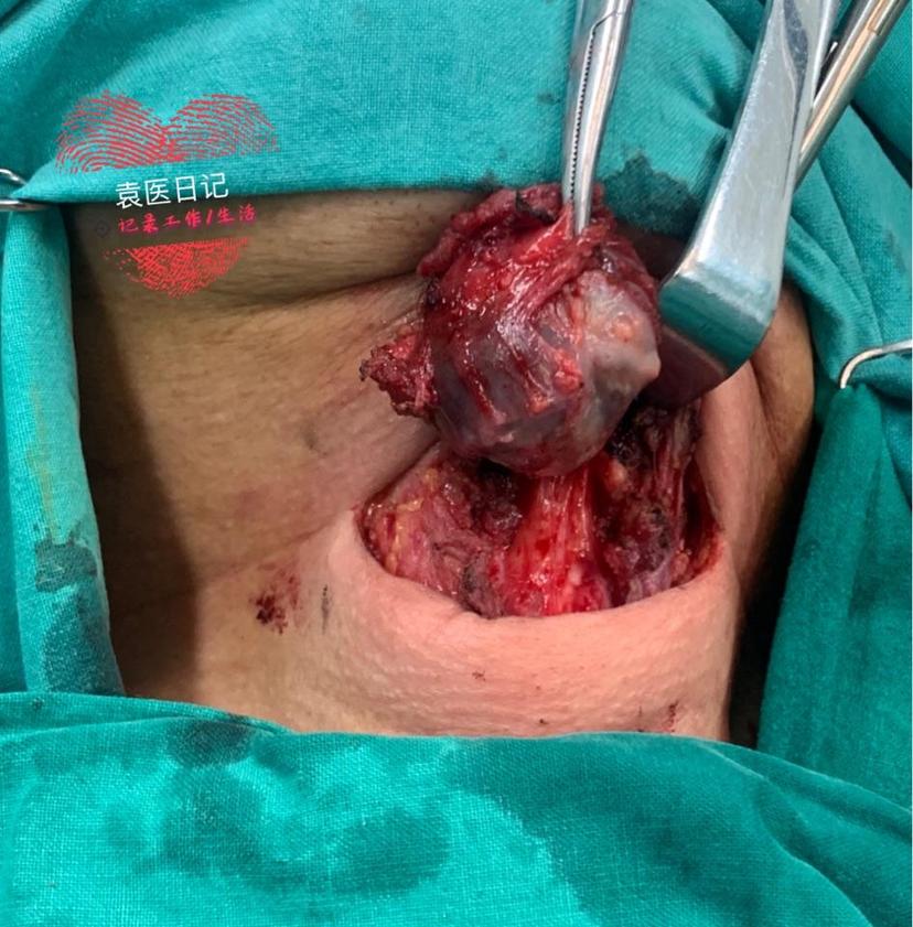 袁医日记:别把"粗脖子"都当成甲状腺病变 - 微医(挂号网)