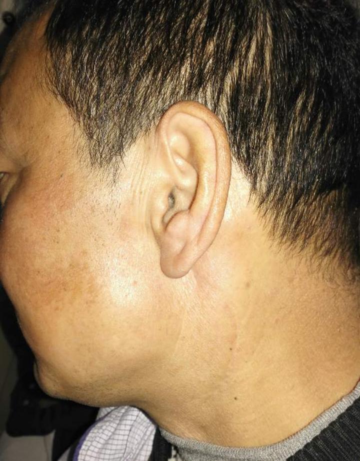 腮腺混合瘤术后疤痕明显吗?