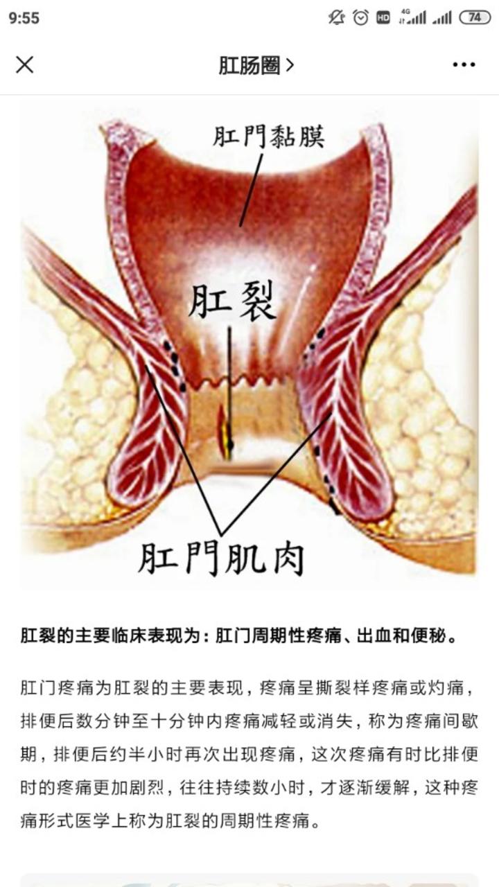 让人苦不堪言的肛裂该如何预防
